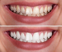 close up of smile before and after teeth whitening