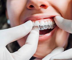 Dentist putting clear aligner on patient