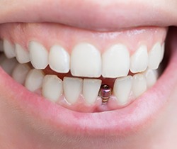 Woman at the dentist with tooth pain